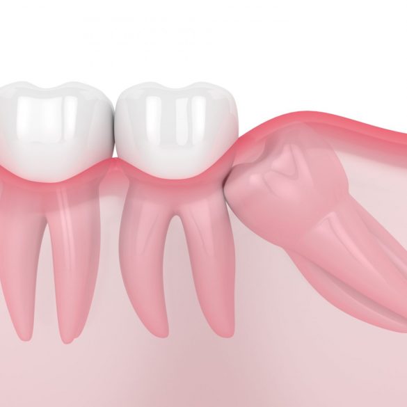 جراحة سحب الأسنان المطمورة