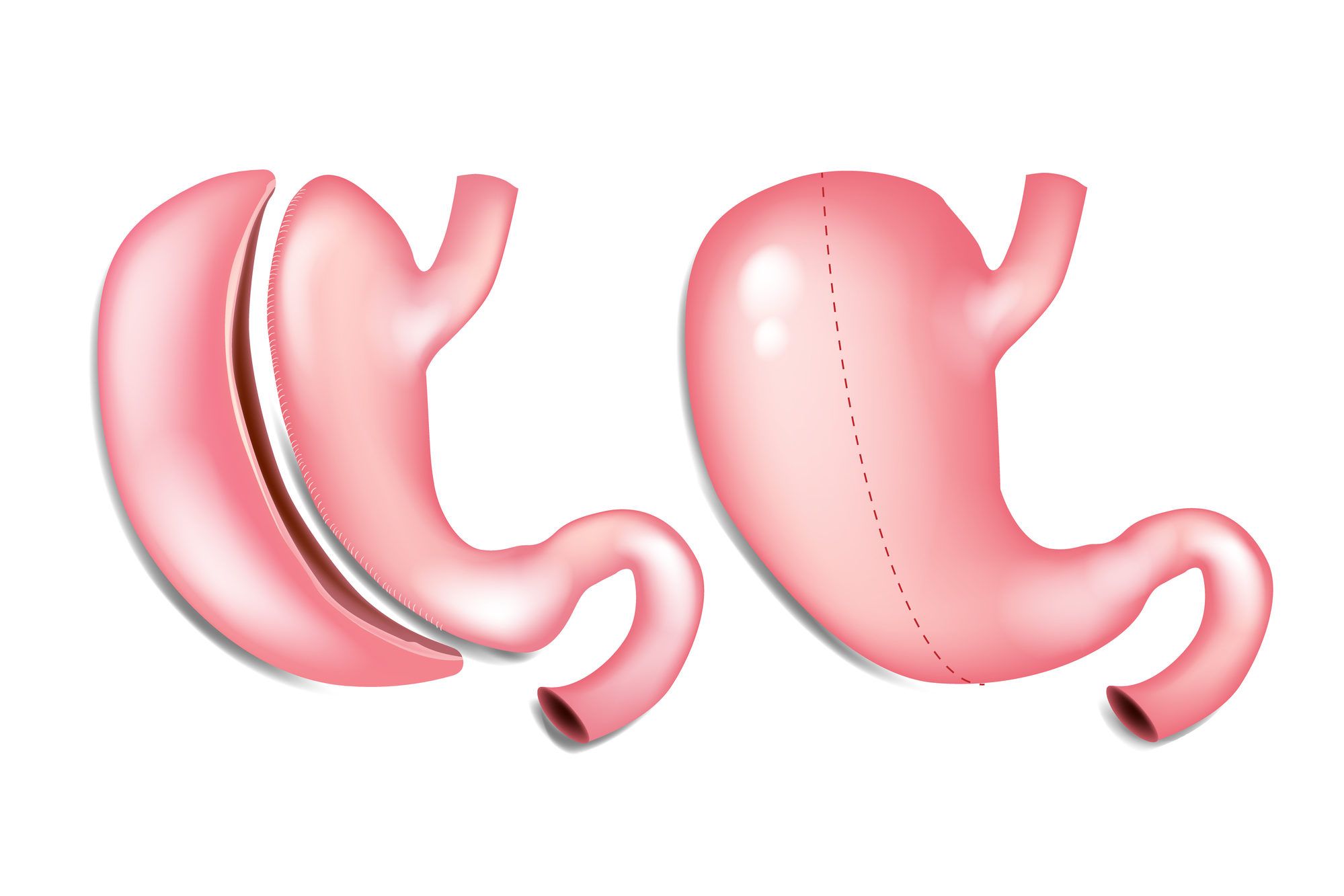 جراحات السمنة