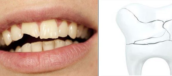 الضرس المكسور