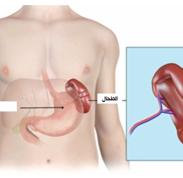 تضخم الطحال